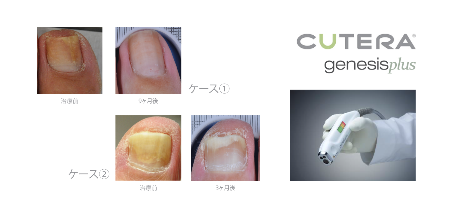 mika-hayashi-林美香足病科クリニック-laser-toenail-fungus-レーザー治療‐爪水虫2